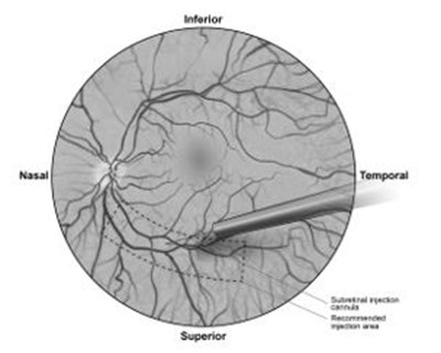 Figure 5b.  Tip Of The Subretinal Injection Cannula Placed Within The Recommended Site Of Injection (surgeon’s Point Of View) (Lux 07)