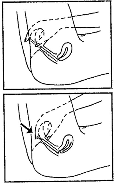 Tioconazole_oint_fig3-01 (Tioconazole Oint Fig3 01)