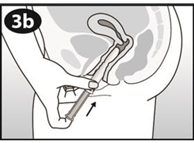 Figure 3b (Nuvaring 20)
