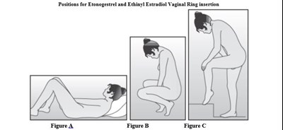Positions for Ring Insertion - eto ee ring figure 6