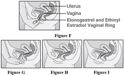 Ring Insertion (Eto Ee Ring Figure 9)