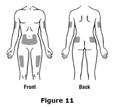 epogen-0a.jpg Do not inject Epogen into an area that is tender, red, bruised, hard, or has scars or stretch marks. Recommended sites for injection are shown in Figure 11 below, including:○ The outer area of the upper arms ○ The abdomen (except for the 2-inch area around the navel)○ The front of the middle thighs○ The upper outer area of the buttocks - epogen 0a