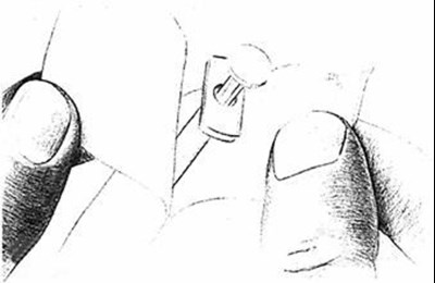 Figure D (Leuprolide Acetate Injection 5)