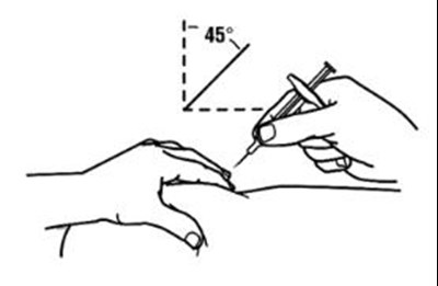 4.	With A Quick And “dart Like” Motion, Insert The Needle At A 45 Degree Angle Into The Skin. (Enbrel 1f)
