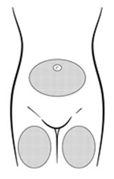 Figure B (Depo Subq Provera 02)