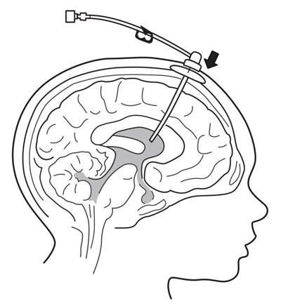 Figure 3 (Brineura 3)