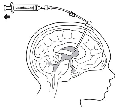 Figure 4 (Brineura 4)