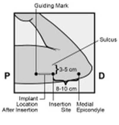 Figure 2a (Nexplanon 03)