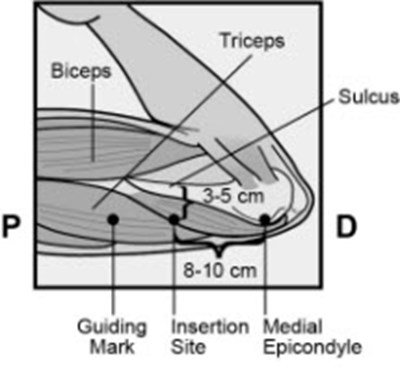 Figure 2b (Nexplanon 04)