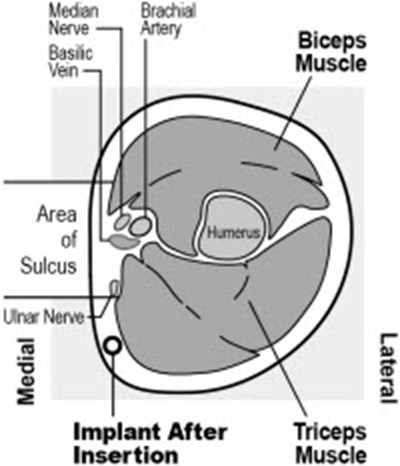 Figure 2c (Nexplanon 05)