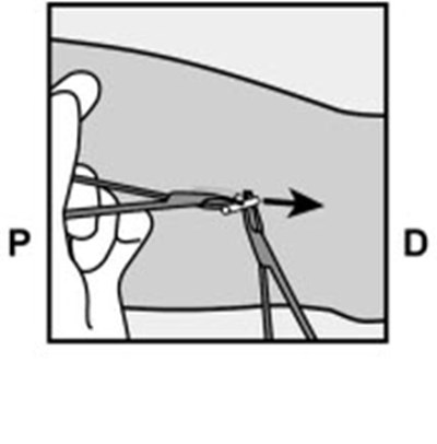 Figure 18 (Nexplanon 28)