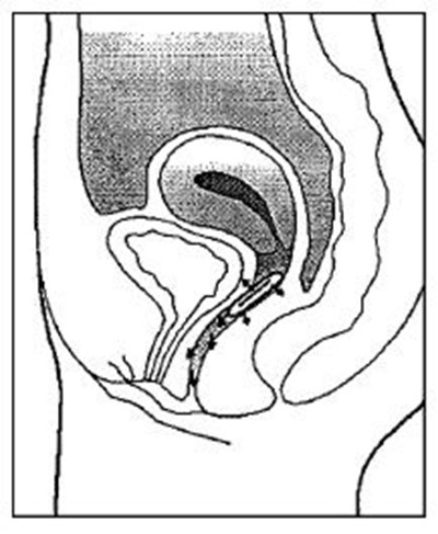 Figure (Estring 06)