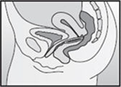 Figure H (Nuvaring 10)