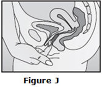 Figure J (Nuvaring 12)