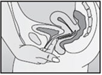 Figure G - nuvaring 09