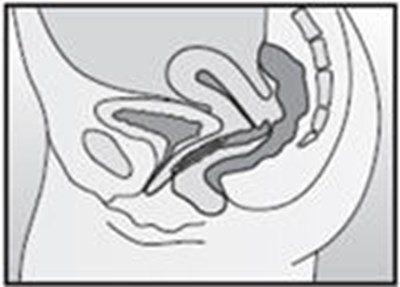 Figure I - nuvaring 11