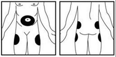 Injection Site Figure (Image 52)