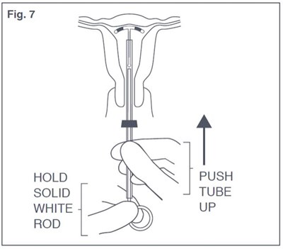 Hold The Insertion Tube Steady And Withdraw The Solid White Rod (fig. 6). (Paragard 07)
