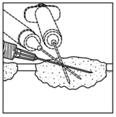imlygic-01.jpg Figure 1: Injection administration for cutaneous lesions - imlygic 01