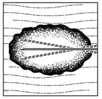 Figure 3: Injection Administration For Nodal Lesions (Imlygic 03)