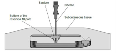 figure 6 - lioresal intrathecal baclofen injection 13