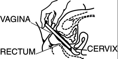 Figure (Clindamycin Phosphate Vaginal Cream 05)