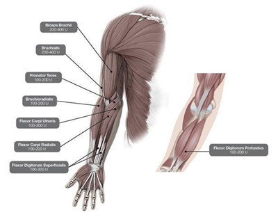 Figure 2 (Dysport 02)