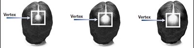 Minoxidil Vertex Image (Image 01)