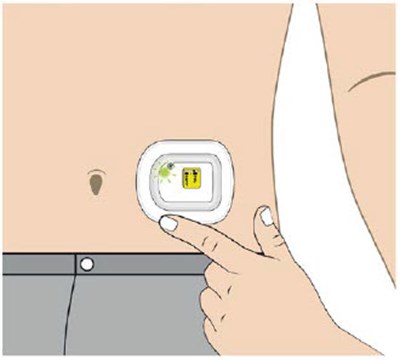 Image 17 (UDENYCA ONBODY injector)