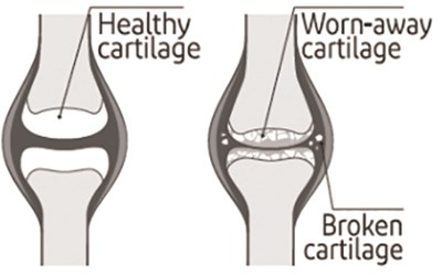 Oa Cartilage (Diclofenac Sodium Topical Gel Otc 13)