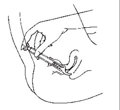 Insert The Fillled Applicator Into The Vagina As Far As It Will Comfortably Go. (Terconazole 04)