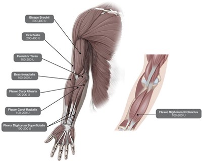Figure 2 (Dysport 02)