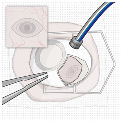 Figure 3 (Susvimo 116)