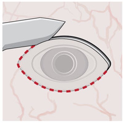 Figure 4 (Susvimo 117)