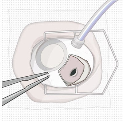 Figure 10 (Susvimo 124)