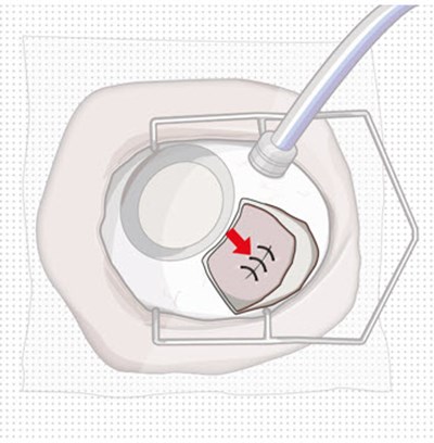 Figure 11 (Susvimo 126)
