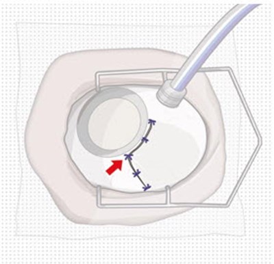 Figure 12 (Susvimo 128)