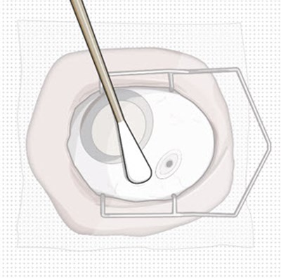 Figure 21 (Susvimo 21)