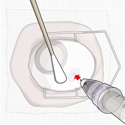 Figure 23 (Susvimo 23)