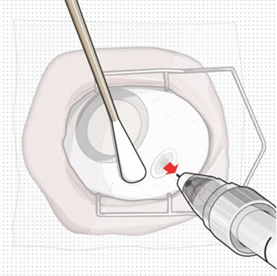 Figure 26 (Susvimo 26)