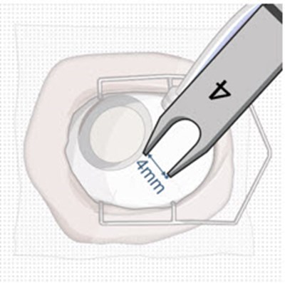 Figure 11 (Susvimo 45)