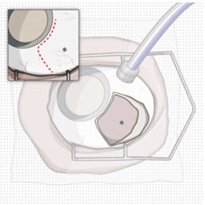 Figure 12 (Susvimo 47)