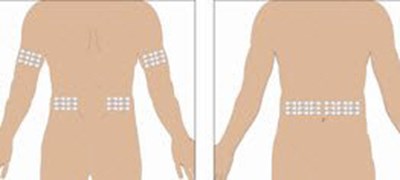 image-03.jpg Select the number of infusion sites depending on the volume of the total dose. See administration for recommended maximum volumes and rates. Potential sites for infusion include the back of arms, abdomen, thighs, and lower back (see Figure below). Ensure sites are at least 2 inches apart; avoid bony prominences. - image 03