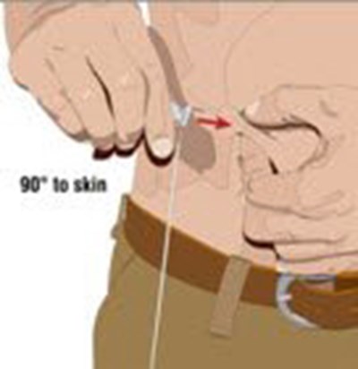 image-05.jpg Choose the correct needle length to assure that GAMMAGARD LIQUID is delivered into the subcutaneous space. Grasp the skin and pinch at least one inch of skin between two fingers. Insert needle at a 90 degree angle with a darting motion into the subcutaneous tissue. Secure the needle. - image 05