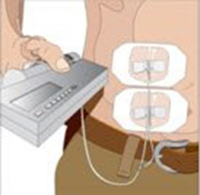 Secure The Needle(s) In Place By Applying A Sterile Protective Dressing Over The Site. (Image 07)