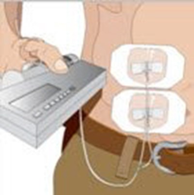 Secure The Needle(s) In Place By Putting A Sterile Clear Bandage Over The Needle. (Image 16)