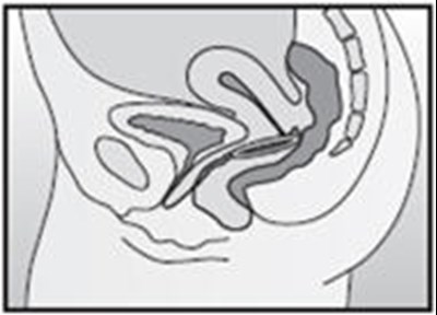 Figure H (Nuvaring 10)