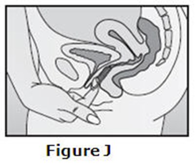 Figure J (Nuvaring 12)