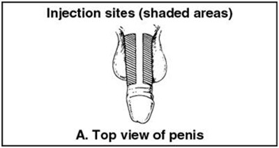 caverject-01.jpg Figure A - caverject 01