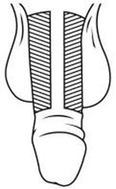 Figure O (Caverject 20)